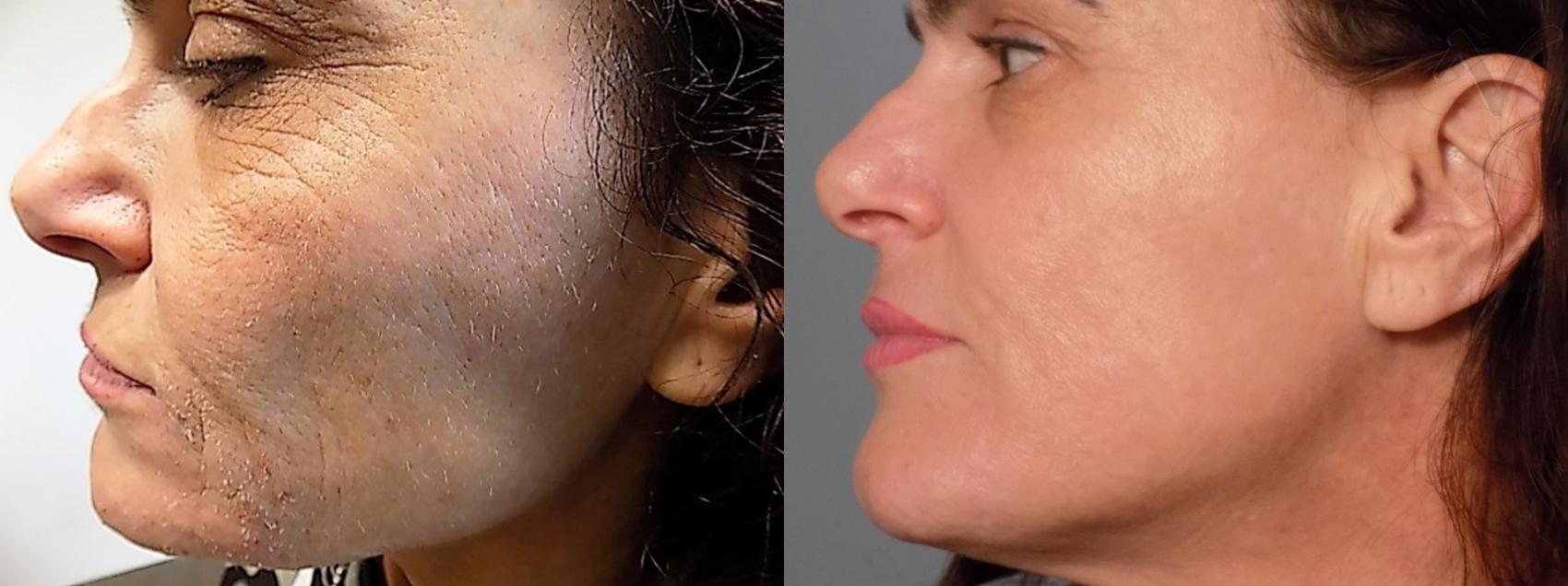 Before & After Microneedling Case 65 Left Side View in Los Angeles, CA