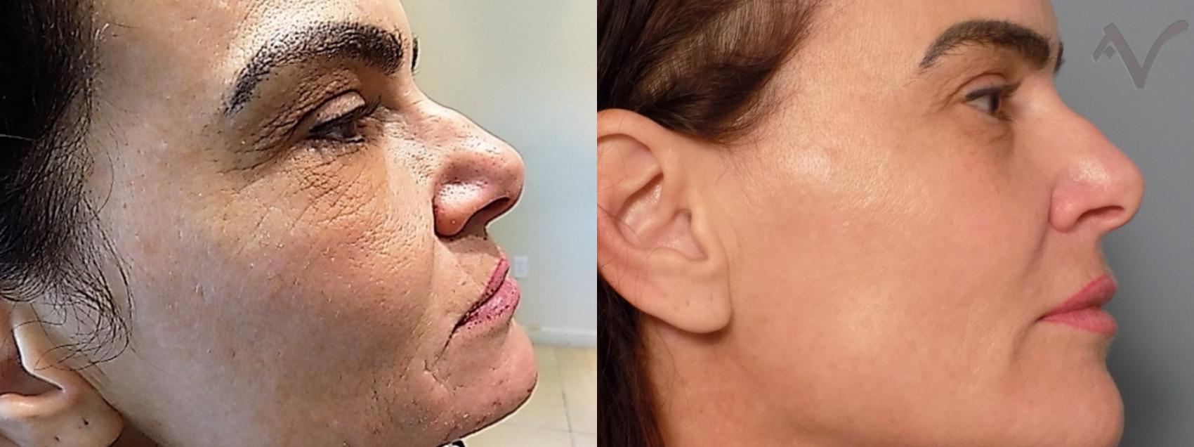 Before & After Microneedling Case 65 Right Side View in Burbank, CA