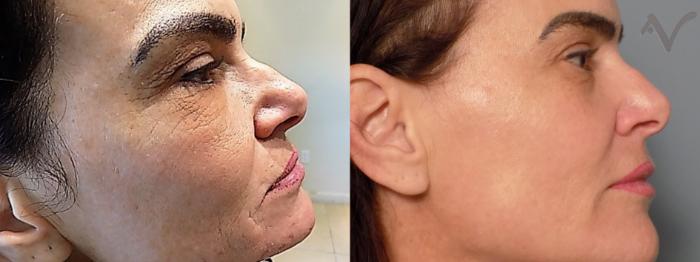 Before & After Microneedling Case 65 Right Side View in Los Angeles, CA