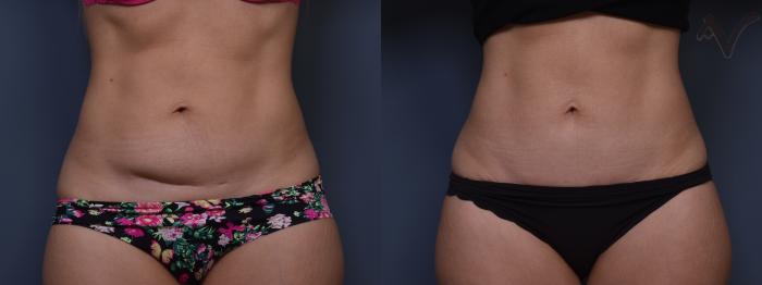 Before & After Mini Abdominoplasty Case 382 Front View in Los Angeles, CA
