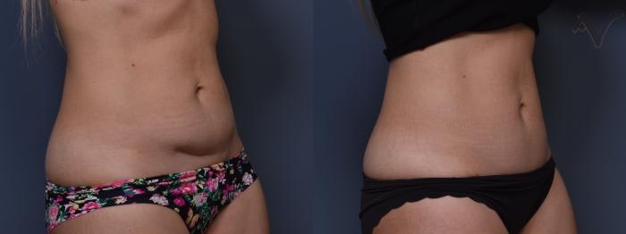 Before & After Mini Abdominoplasty Case 382 Right Oblique View in Los Angeles, CA