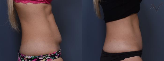 Before & After Mini Abdominoplasty Case 382 Right Side View in Los Angeles, CA