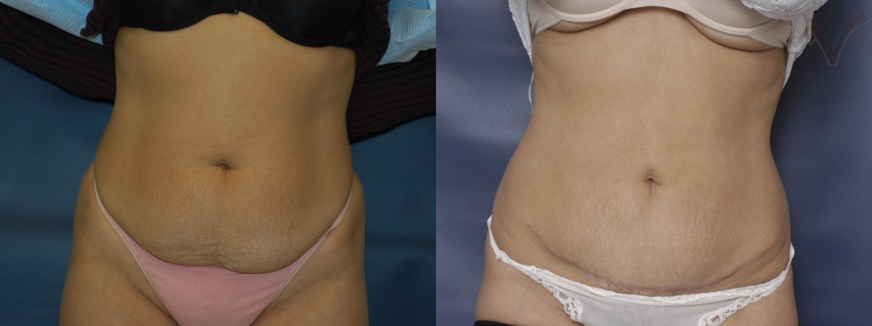 Before & After Mini Abdominoplasty Case 51 Front View in Burbank, CA