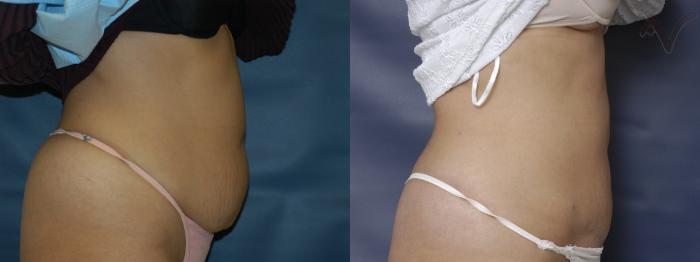 Before & After Mini Abdominoplasty Case 51 Right Side View in Los Angeles, CA