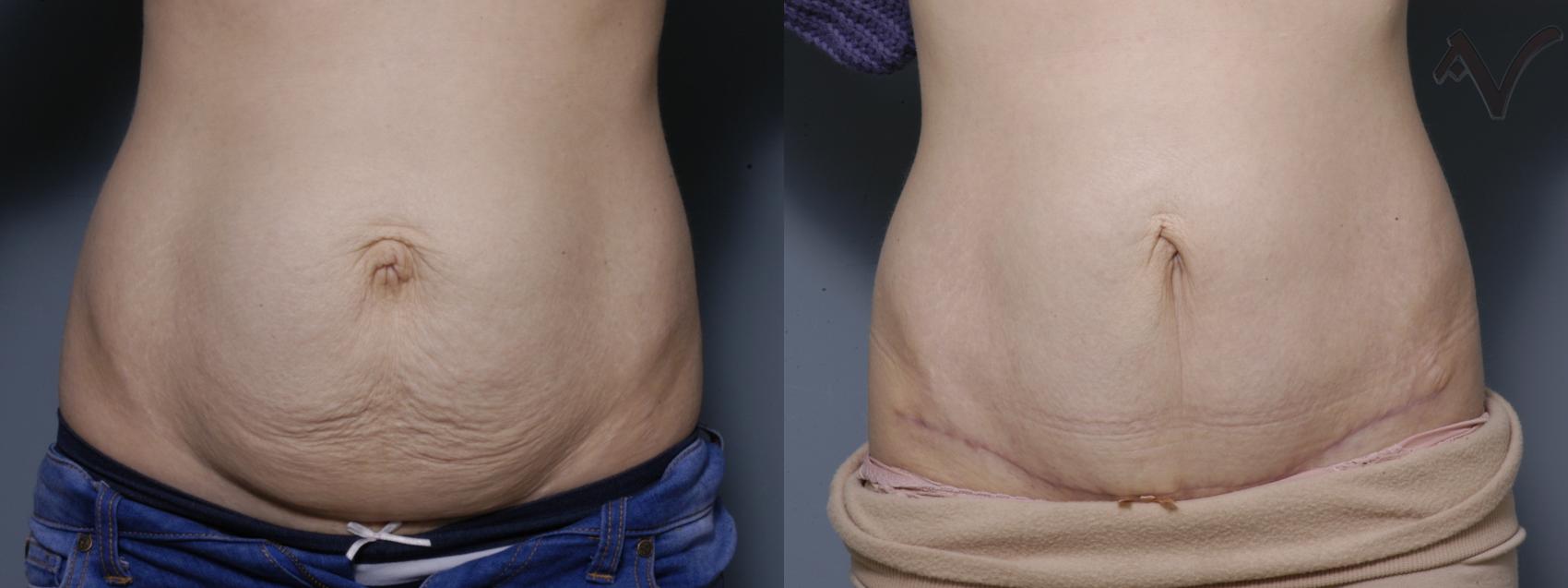 Before & After Mini Abdominoplasty Case 52 Front View in Los Angeles, CA