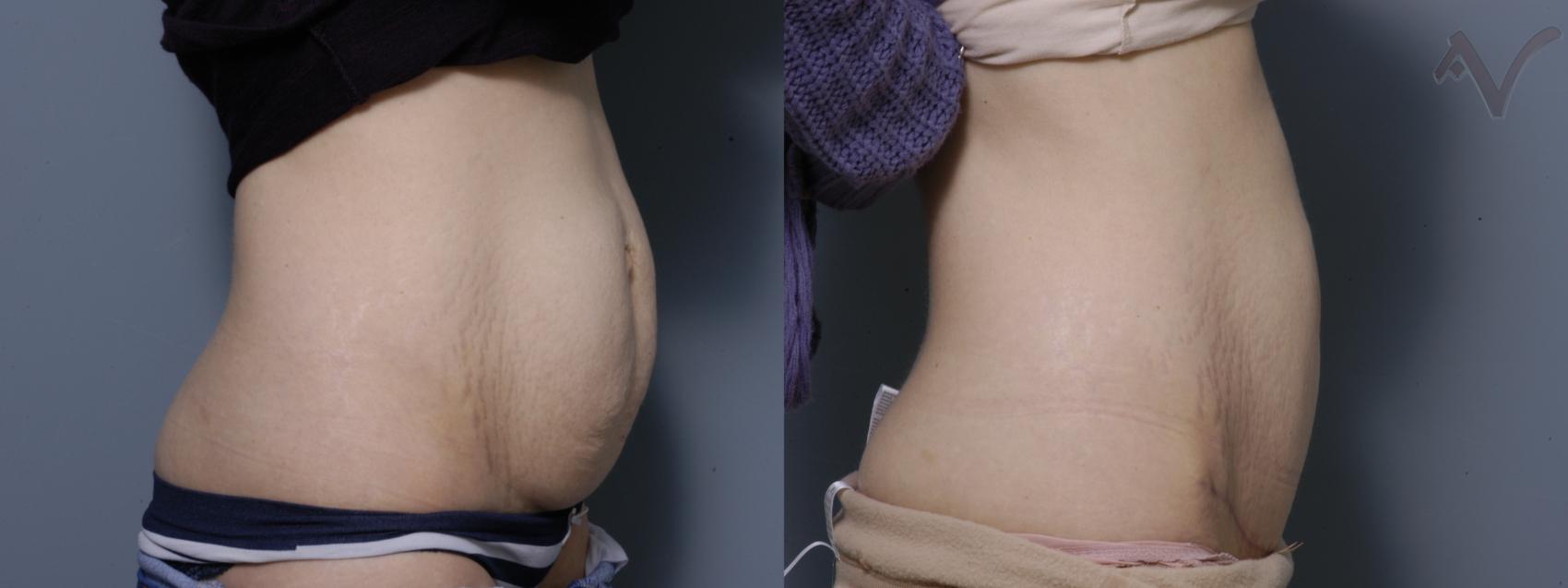 Before & After Mini Abdominoplasty Case 52 Right Side View in Burbank, CA