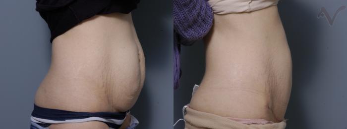 Before & After Mini Abdominoplasty Case 52 Right Side View in Los Angeles, CA