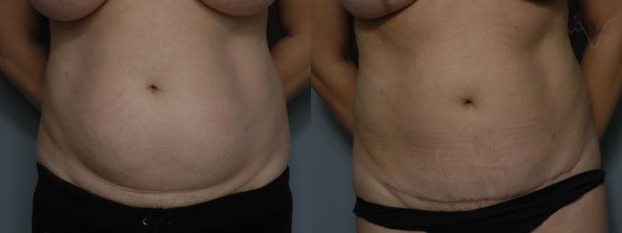 Before & After Mini Abdominoplasty Case 53 Front View in Los Angeles, CA