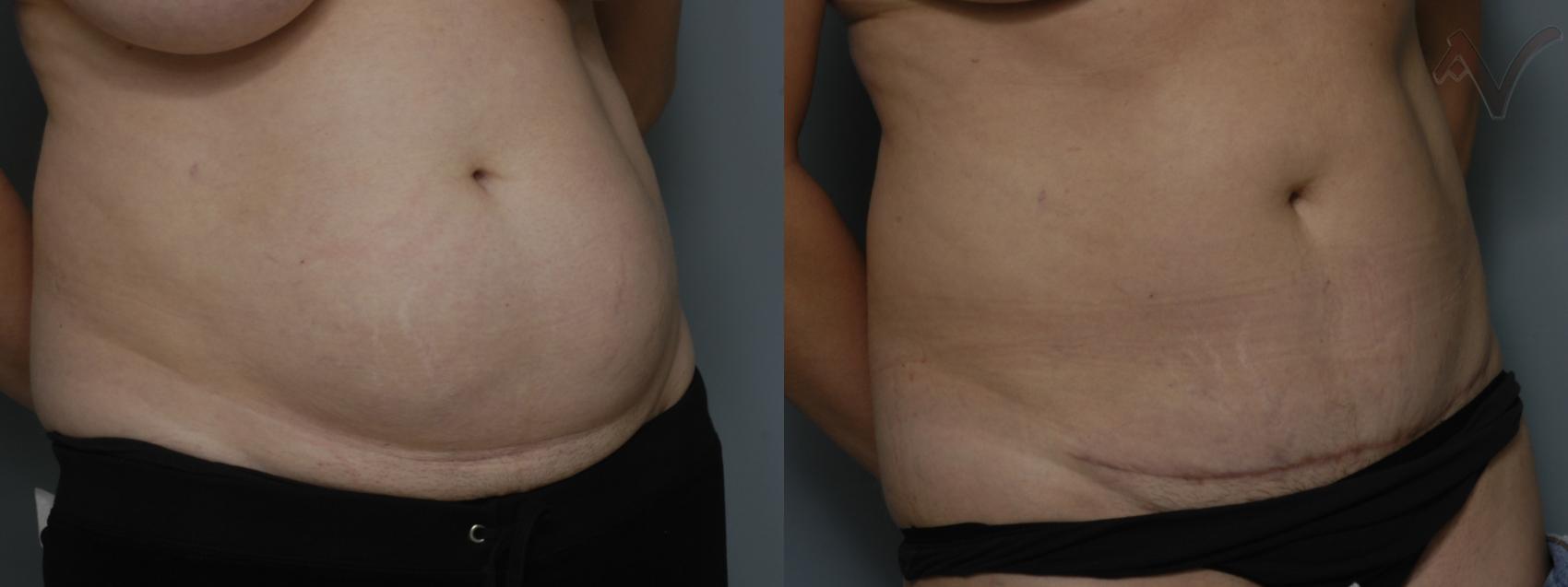 Before & After Mini Abdominoplasty Case 53 Right Oblique View in Burbank, CA