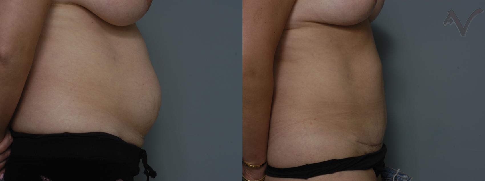 Before & After Mini Abdominoplasty Case 53 Right Side View in Burbank, CA