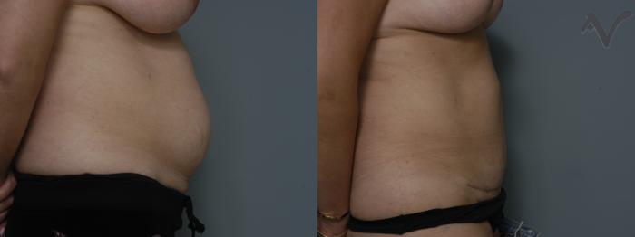 Before & After Mini Abdominoplasty Case 53 Right Side View in Los Angeles, CA