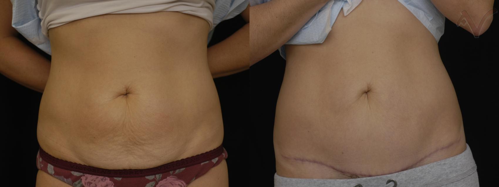 Before & After Mini Abdominoplasty Case 54 Front View in Los Angeles, CA