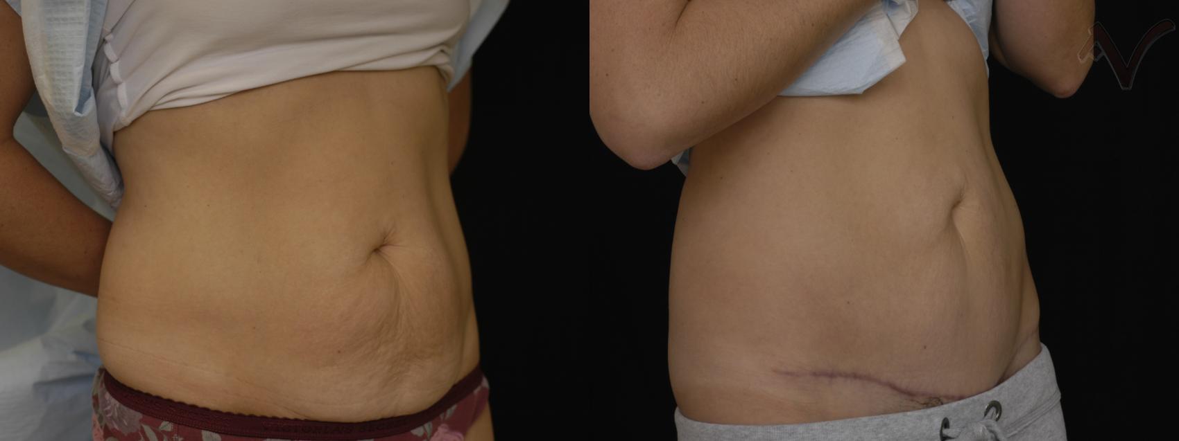 Before & After Mini Abdominoplasty Case 54 Right Oblique View in Los Angeles, CA