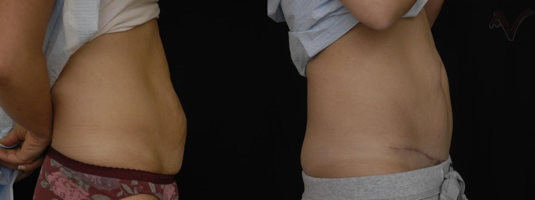 Before & After Mini Abdominoplasty Case 54 Right Side View in Los Angeles, CA
