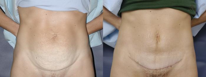 Before & After Mini Abdominoplasty Case 55 Front View in Los Angeles, CA