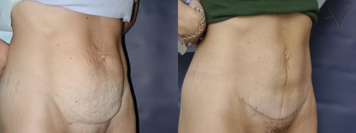 Before & After Mini Abdominoplasty Case 55 Right Oblique View in Los Angeles, CA