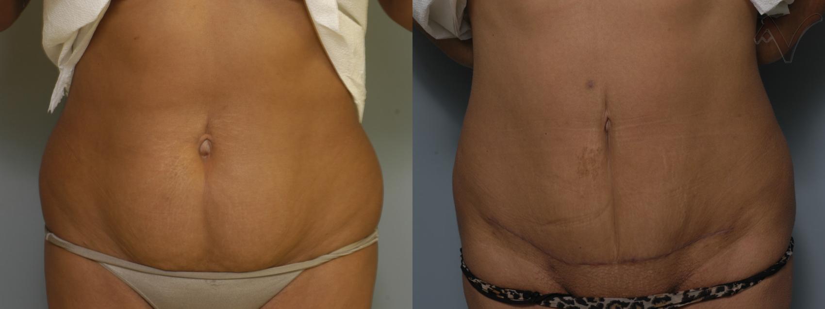 Before & After Mini Abdominoplasty Case 56 Front View in Los Angeles, CA
