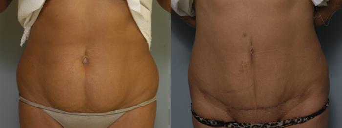 Mini Abdominoplasty Before and After Photo Gallery