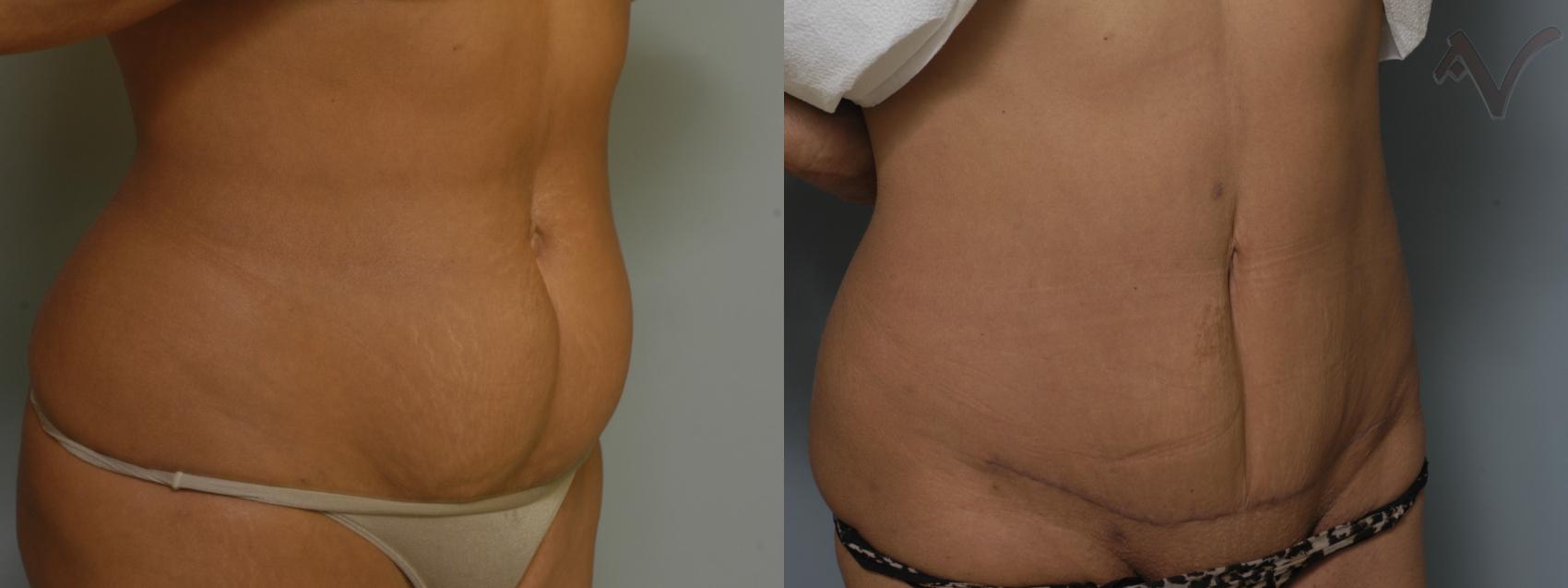 Before & After Mini Abdominoplasty Case 56 Right Oblique View in Burbank, CA