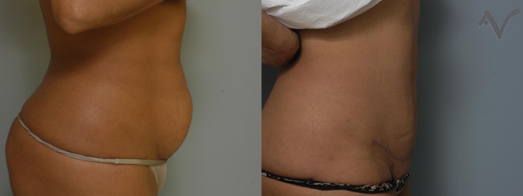 Before & After Mini Abdominoplasty Case 56 Right Side View in Burbank, CA