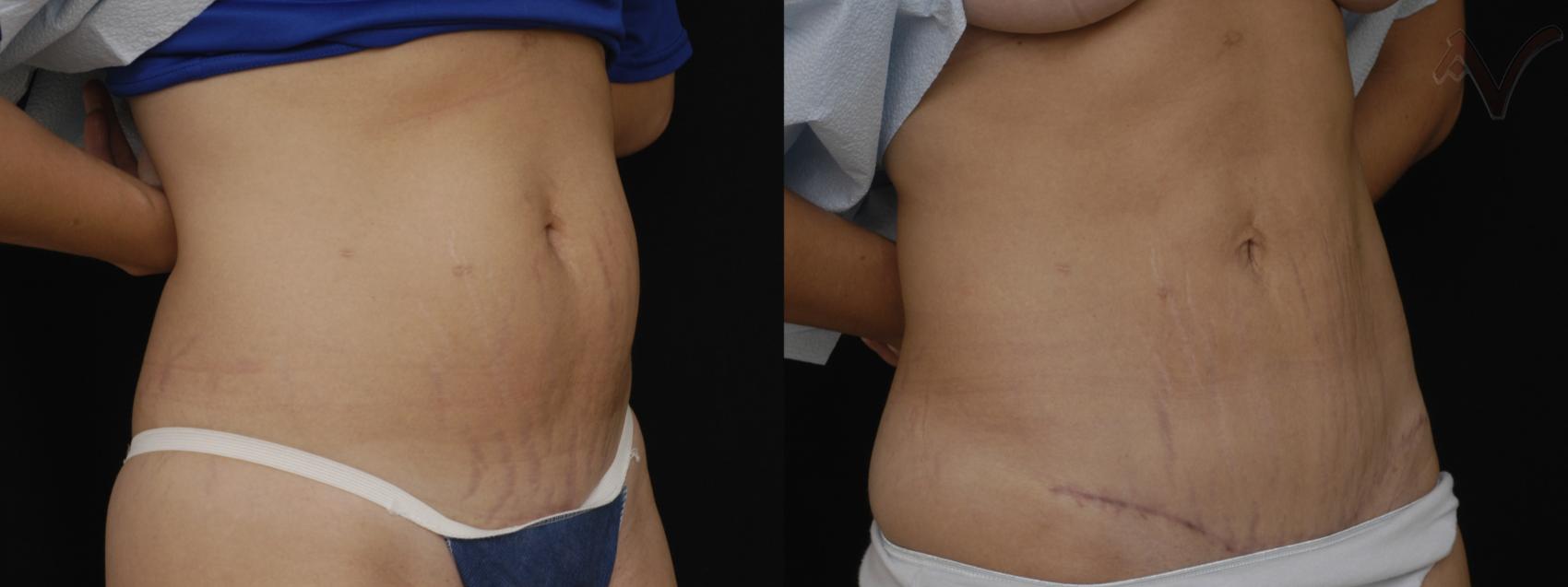 Before & After Mini Abdominoplasty Case 69 Right Oblique View in Burbank, CA