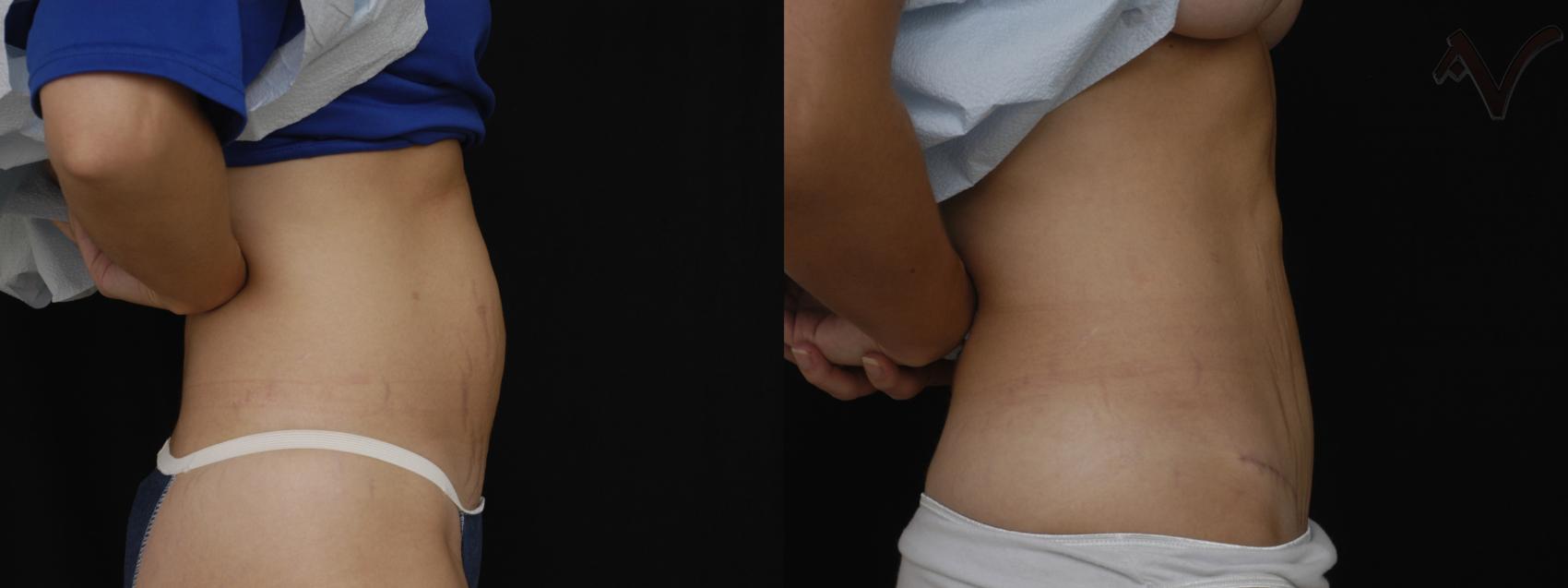 Before & After Mini Abdominoplasty Case 69 Right Side View in Burbank, CA