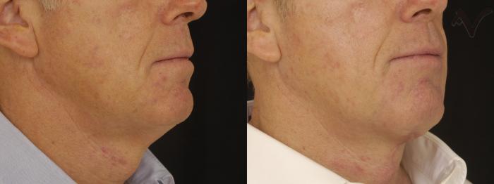Before & After Neck Lift Case 235 Right Oblique View in Los Angeles, CA