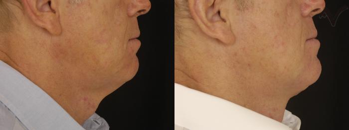 Before & After Neck Lift Case 235 Right Side View in Los Angeles, CA