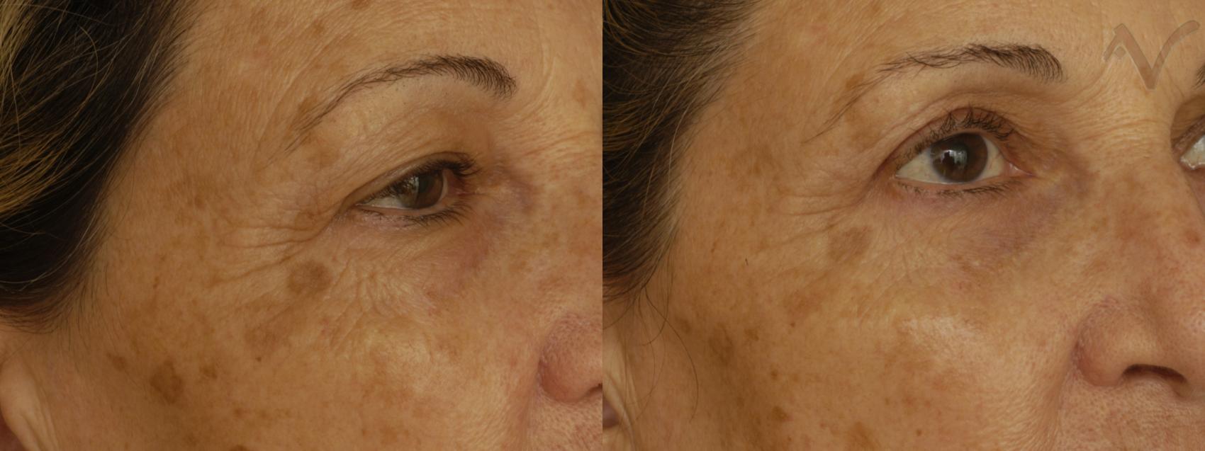 Before & After Pearl Laser Case 27 Right Oblique View in Burbank, CA