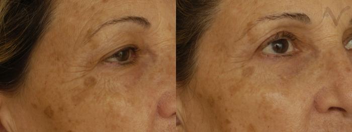 Before & After Pearl Laser Case 27 Right Oblique View in Los Angeles, CA
