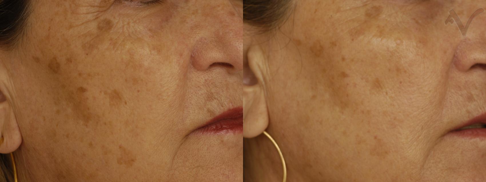Before & After Pearl Laser Case 27 Right Side View in Los Angeles, CA