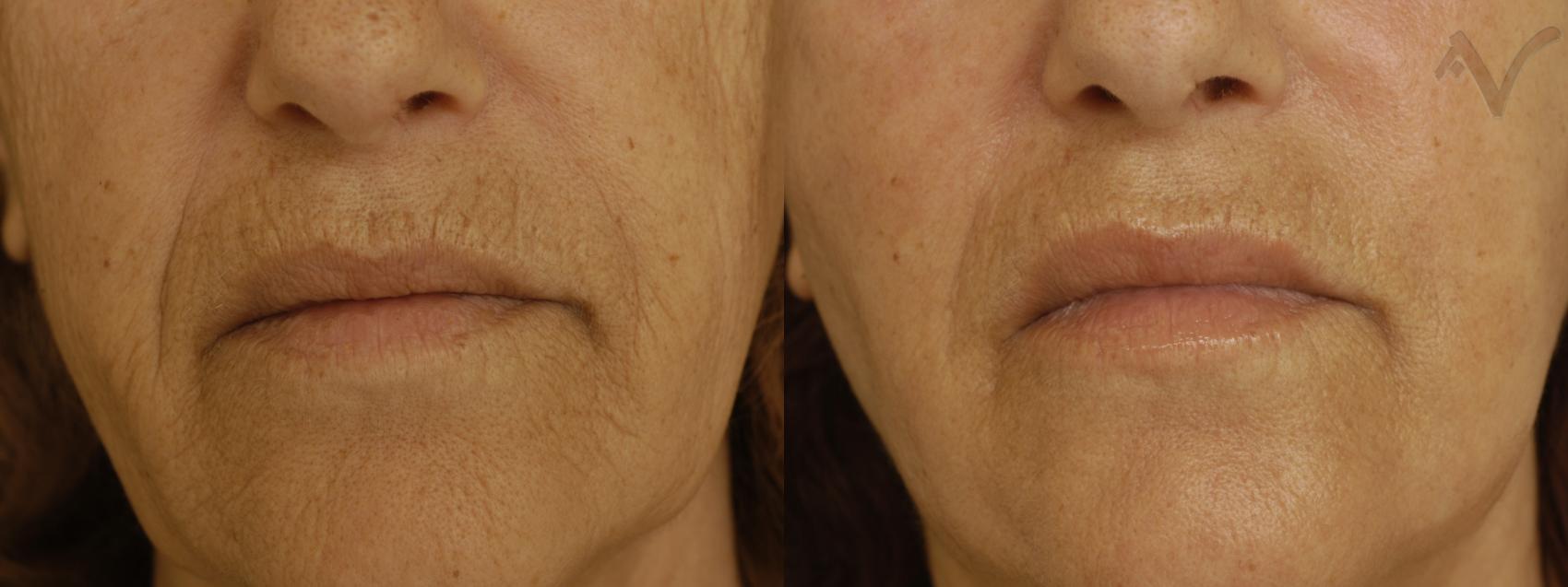 Before & After Pearl Fractional Laser Case 28 Close up, Peri-oral View in Burbank, CA