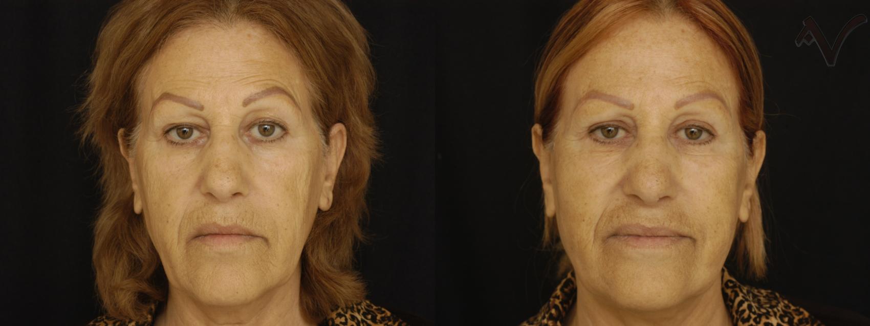 Before & After Pearl Fractional Laser Case 28 Front View in Los Angeles, CA