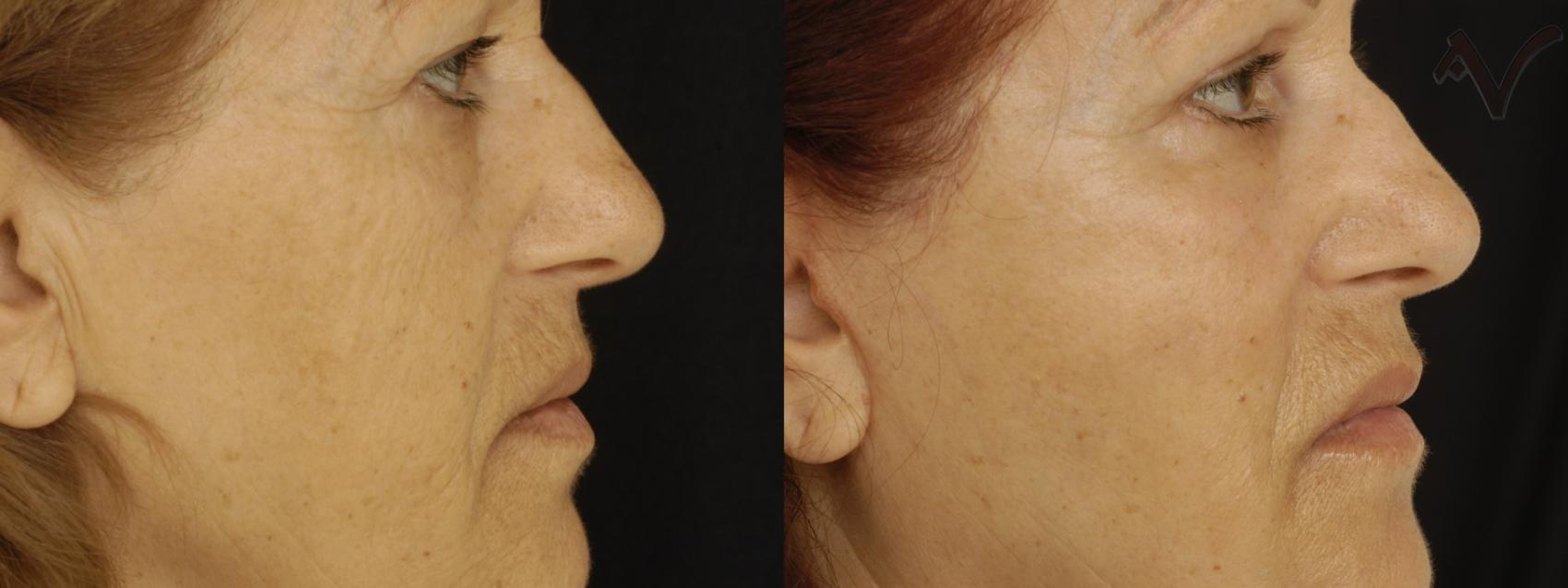 Before & After Pearl Fractional Laser Case 28 Right Side View in Burbank, CA
