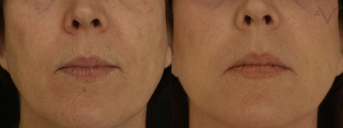 Before & After Pearl Fractional Laser Case 29 Front View in Los Angeles, CA