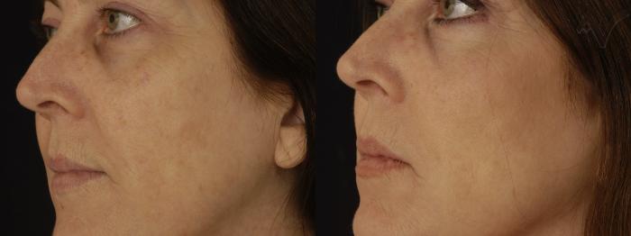 Before & After Pearl Fractional Laser Case 29 Left Side View in Los Angeles, CA