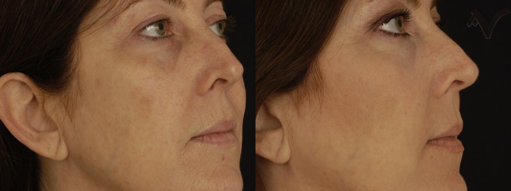 Before & After Pearl Fractional Laser Case 29 Right Side View in Burbank, CA