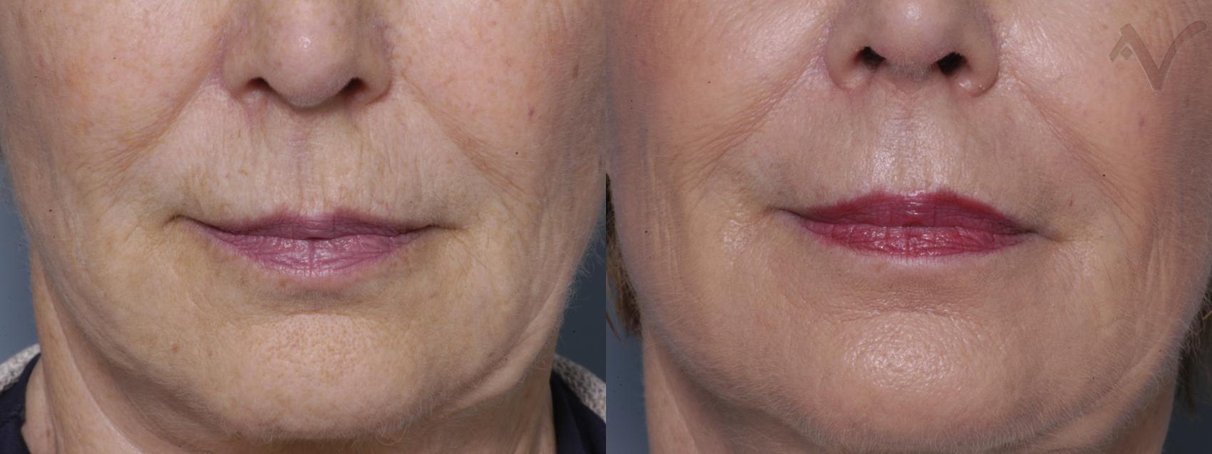 Before & After Pearl Fractional Laser Case 30 Front View in Los Angeles, CA