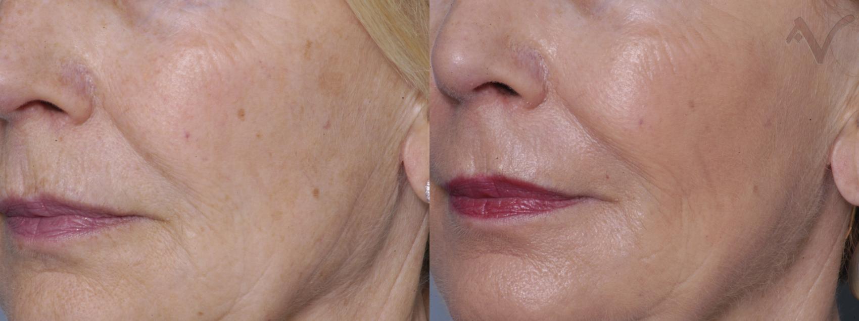 Before & After Pearl Laser Case 30 Left Oblique View in Burbank, CA
