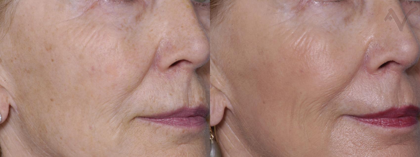 Before & After Pearl Fractional Laser Case 30 Right Oblique View in Burbank, CA