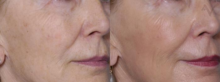 Before & After Pearl Fractional Laser Case 30 Right Oblique View in Los Angeles, CA