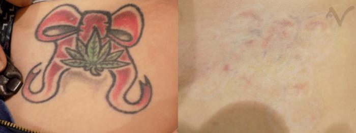 Before & After PicoSure Laser Tattoo Removal Case 31 Front View in Los Angeles, CA