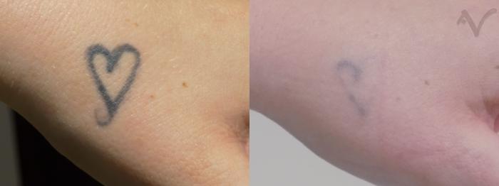 Before & After PicoSure Laser Tattoo Removal Case 31 Left Hand View in Los Angeles, CA