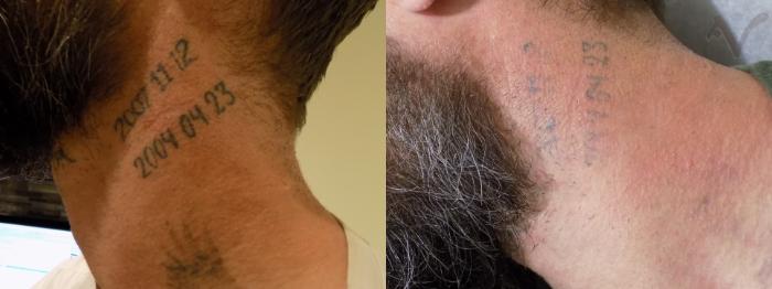 Before & After PicoSure Laser Tattoo Removal Case 32 Left Side View in Los Angeles, CA