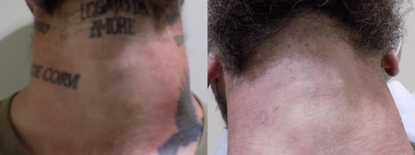 Before & After PicoSure Laser Tattoo Removal Case 32 Neck, Upward Gaze View in Los Angeles, CA