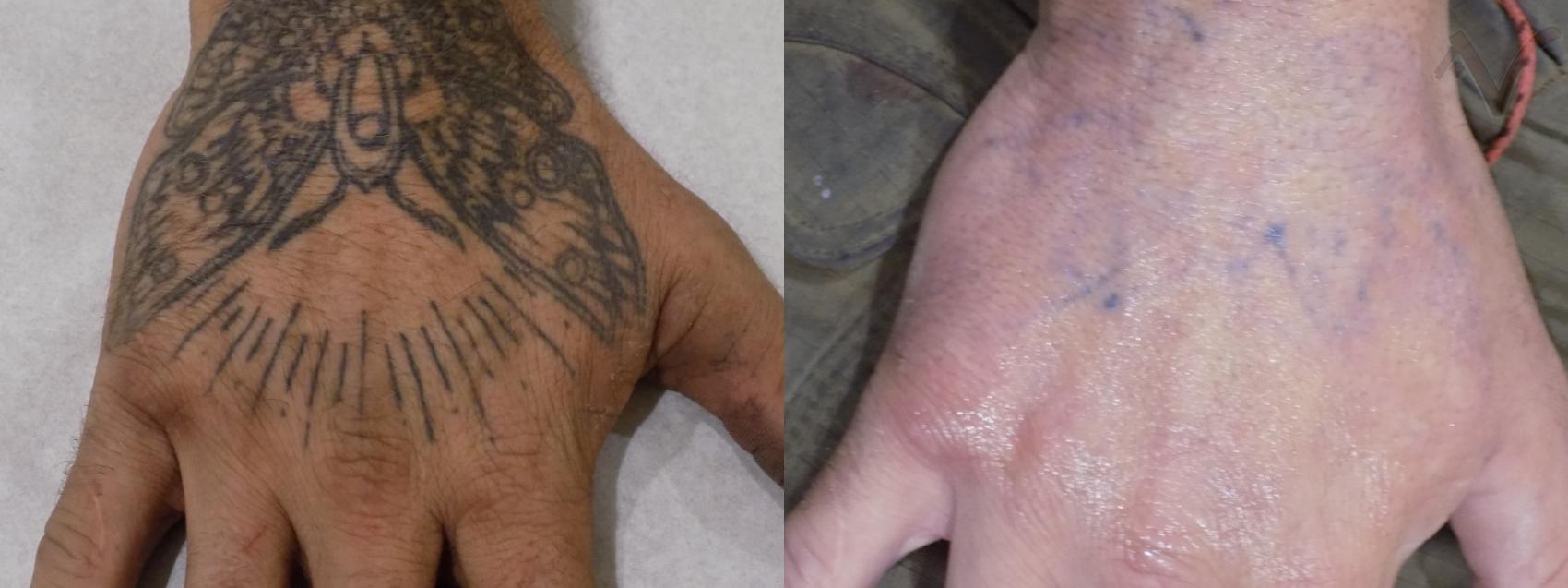 Before & After Laser Tattoo Removal Case 32 Right Hand View in Los Angeles, CA