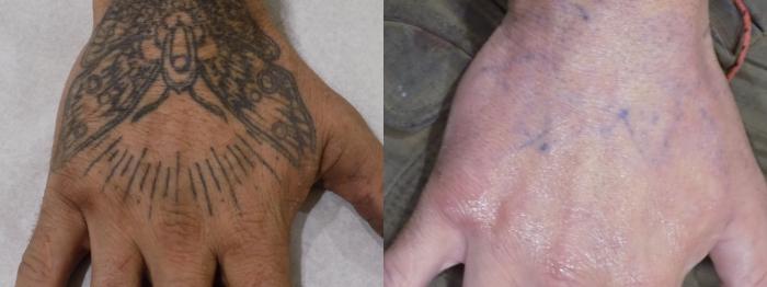 Before & After PicoSure Laser Tattoo Removal Case 32 Right Hand View in Los Angeles, CA