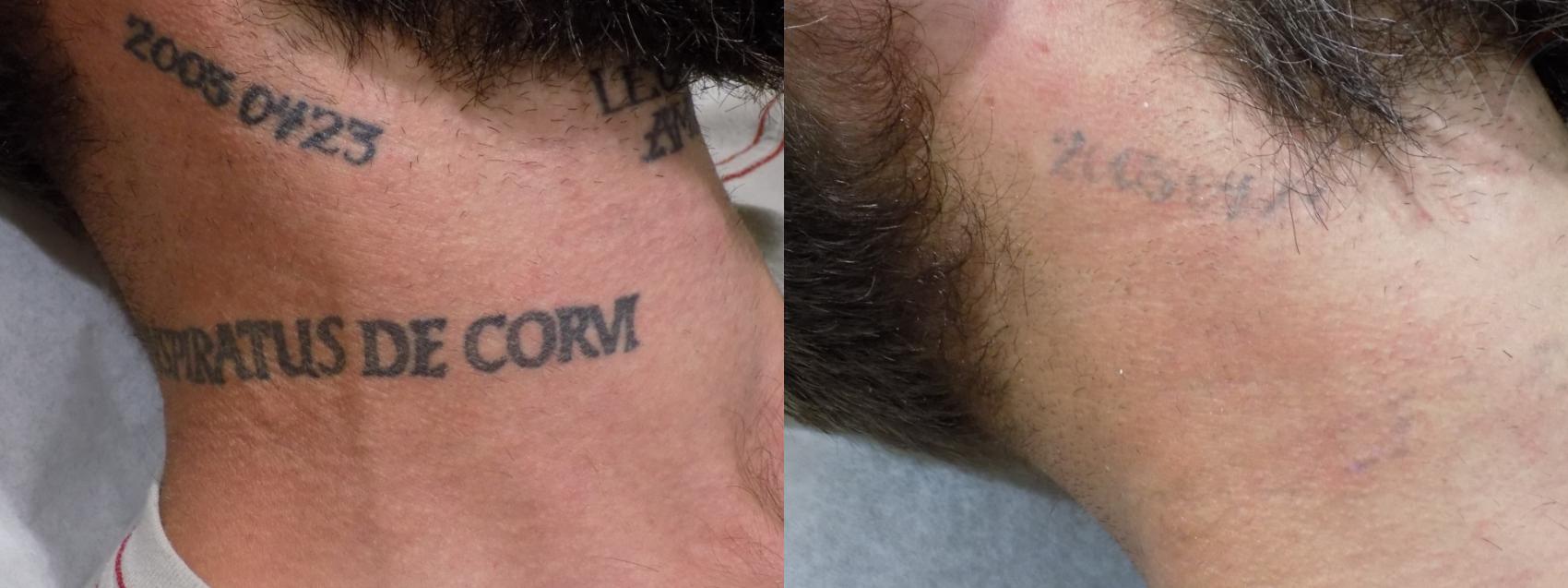 Before & After Laser Tattoo Removal Case 32 Right Side View in Los Angeles, CA