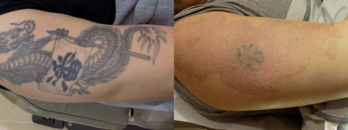 Before & After PicoSure Laser Tattoo Removal Case 322 Right Side View in Los Angeles, CA