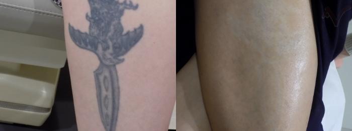 Before & After PicoSure Laser Tattoo Removal Case 323 Right Side View in Los Angeles, CA